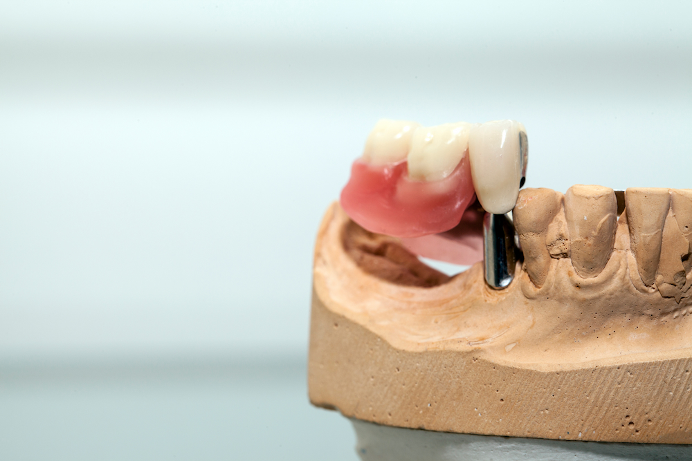 zirconium porcelain tooth plate in dentist store 2023 11 27 05 13 20 utc 1